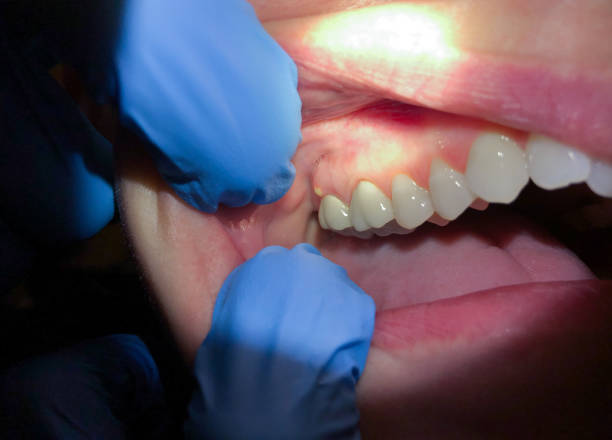 Best Dental Abscess Treatment in Jefferson, OH