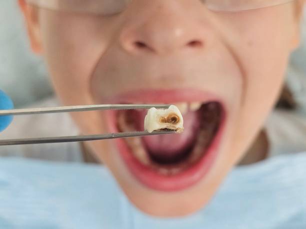 Best Emergency Wisdom Tooth Extraction in Jefferson, OH
